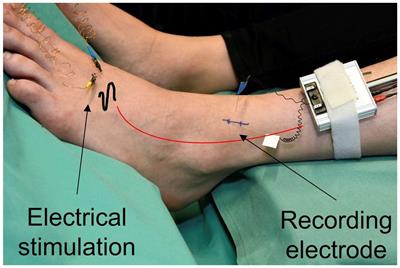 A modelling study to dissect the potential role of voltage-gated ion channels in activity-dependent conduction velocity changes as identified in small fiber neuropathy patients